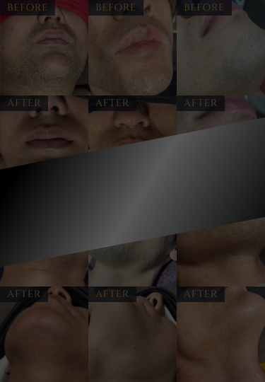脱毛施行前後の男性の顔写真が複数並んでいる
